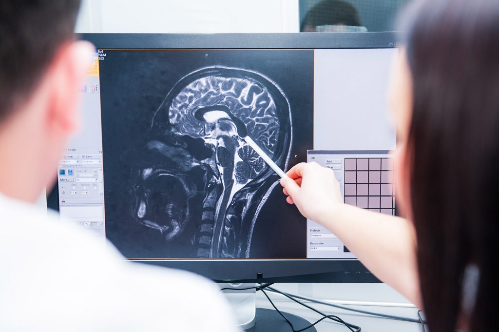 Doctors magnetic resonance image (MRI) injured brain, head injury compensation claim solicitors Sheffield